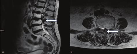 Magnetic resonance image shows spinal epidural hematoma in sagital... | Download Scientific Diagram