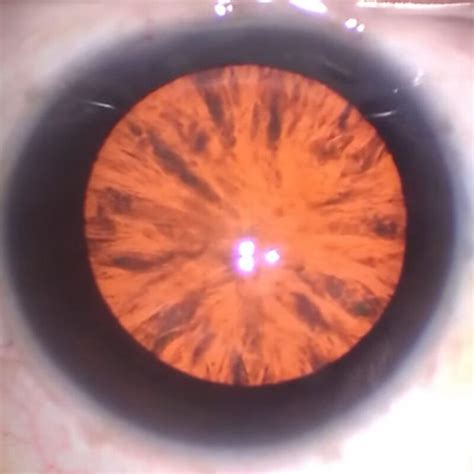 Cortical Cataracts - The Complete Patient Guide | United States