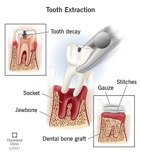 Tooth Extraction: Procedure, Aftercare & Recovery (2023)