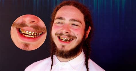 Why Does Post Malone Have Such Teeth? Are They Made Of Silver, Gold, Or Diamonds?