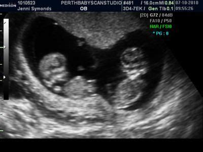 baby at 2 weeks ultrasound - Cordie Mcdougal