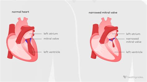 Mitral Valve Stenosis: Causes, Symptoms, Treatments, and More