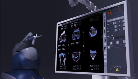 Robotic Knee Replacement Surgery | Mako Robotic Arm System