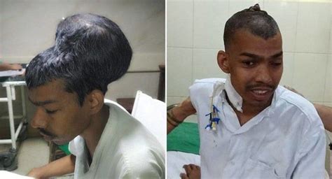 Doctors In India Remove The World's Largest Brain Tumor