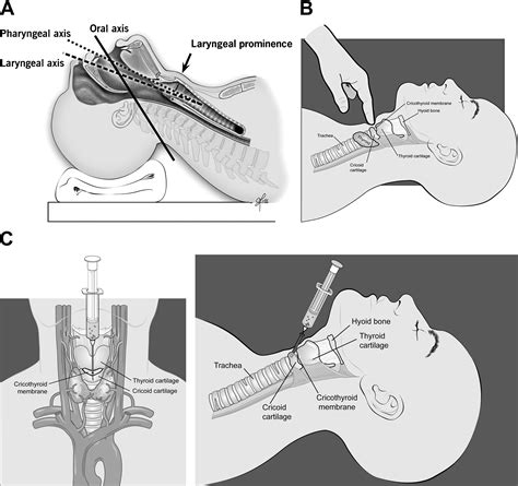 Needle Cricothyrotomy - Emergency Medicine Clinics