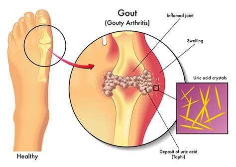 Gout in Foot? Here's How It Happens—and How to Treat It - University Health News