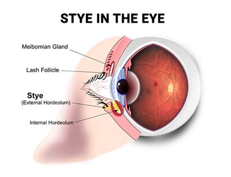 Stye Treatment in NYC - Vitreous Retina Macula Consultants of New York