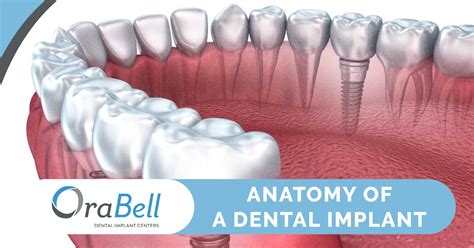 Anatomy of a Dental Implant - Orabell Dental Implants