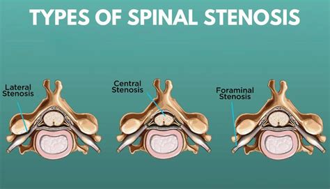 Lateral Recess Stenosis: Wellness Doctor Rx