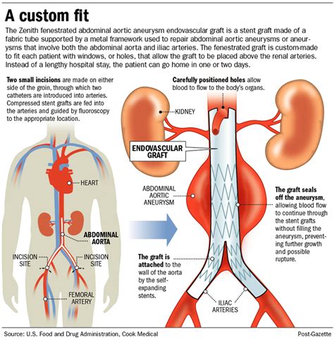 Distensi Abdomen: Penyebab, Gejala, Dan Cara Mengatasinya