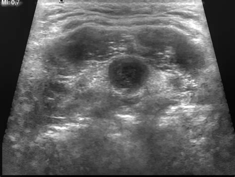 Branchial Cleft Cyst Ultrasound