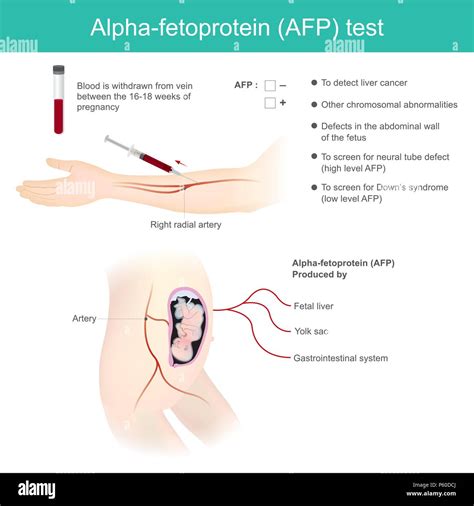 Alpha-fetoprotein (AFP) test. Use Analysis by AFP level. to detect ...