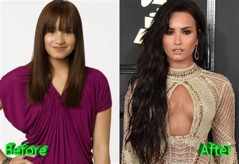 Demi Lovato Plastic Surgery: An Improvement For A Young Star