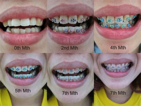 I like the 4thmonth color. comment which colors u like | Braces tips, Braces colors, Dental braces