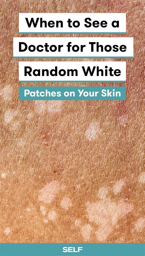 White Patch On Skin: A Cause For Concern?