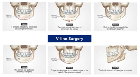 Different types of jaw surgeries: Square jaw, V-line and Mini V-line in 2021 | Jaw surgery ...