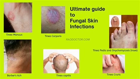 Ultimate Guide To Fungal Skin Infections-How To Tackle Them