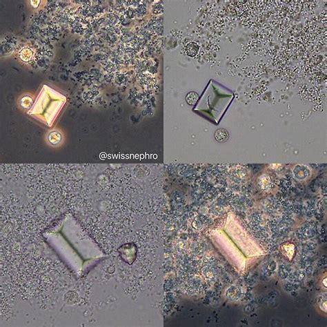 Triple phosphate crystals amorphous phosphates and some leucocytes in a patient with… | Medical ...