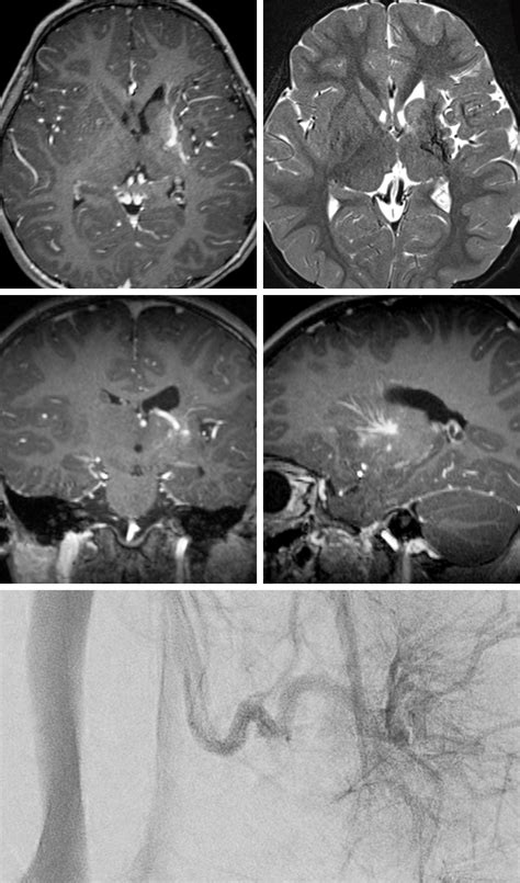 Developmental Venous Anomaly | The Neurosurgical Atlas