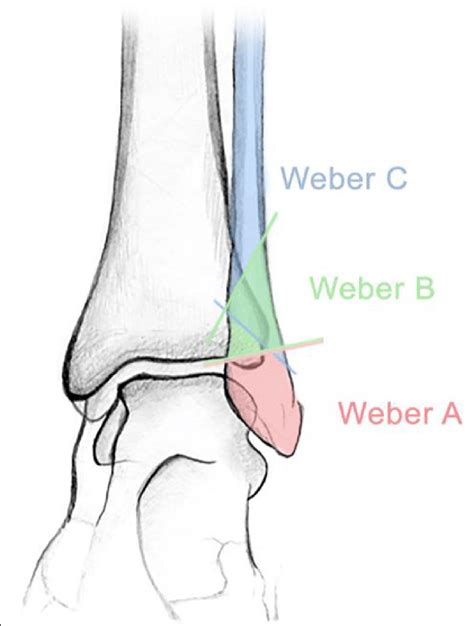 Weber Classification Fibula Fracture