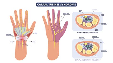 Transverse Carpal Tunnel Surgery Recovery: Does Cutting the Ligament Have Consequences ...