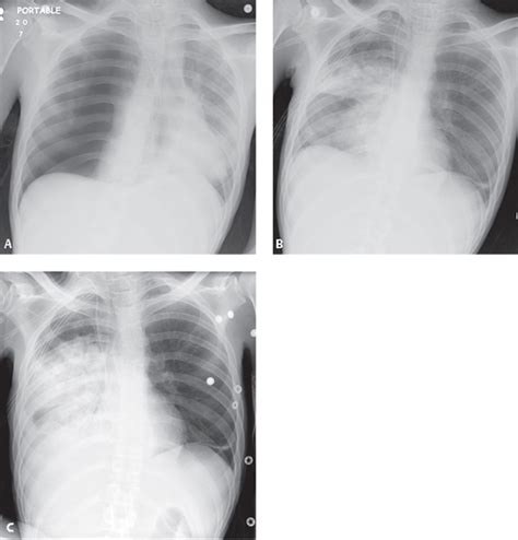 133 Re-Expansion Pulmonary Edema | Radiology Key