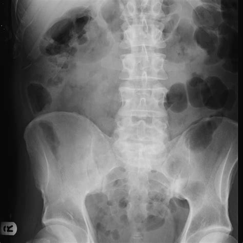 (PDF) Cullen's sign – Case report with a review of the literature