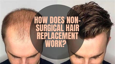 How Does Non-surgical Hair Replacement Work? - Hair Tech Solutions