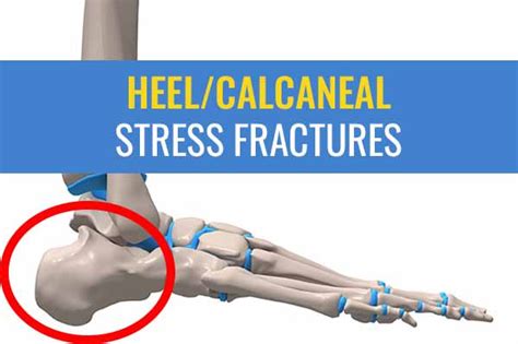 Heel / Calcaneal stress fractures: Causes, symptoms, and treatment