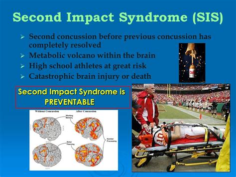 PPT - Management of Concussion For Coaches & Officials In High School ...