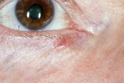 Basal cell skin cancer on eyelid - Stock Image - C013/0954 - Science Photo Library