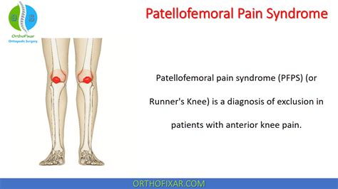 Patellofemoral Pain Syndrome Wikipedia | vlr.eng.br