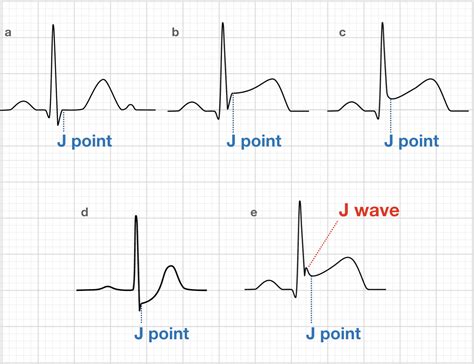 ECG Exam Template • LITFL Medical Blog • ECG Library Basics Heart Rhythms, Ekg Rhythms, Qrs ...