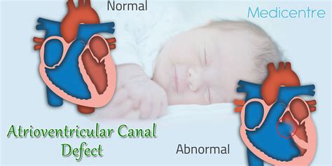 Atrioventricular Canal Defect - Causes, Symptoms & Treatments