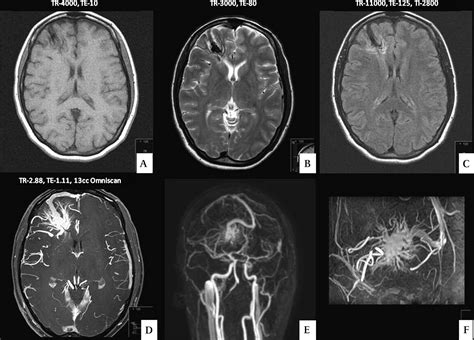 Developmental venous anomaly coexisting with a true arteriovenous ...