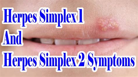 Oral Hsv 1 Vs 2 - Herpes Std : Herpes is separated into two types: