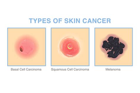 3 Types Of Skin Cancer Illustration About Medical Diagram Of Basal Cell ...