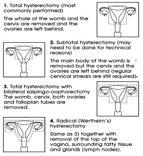 Hysterectomy Meaning