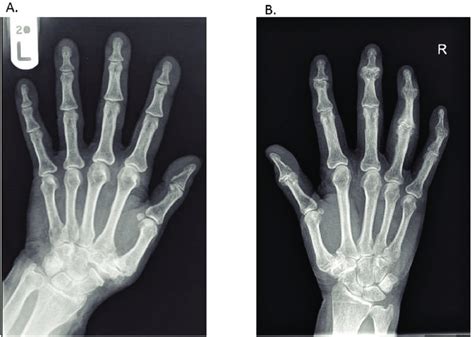 Osteoarthritis Hands X Ray