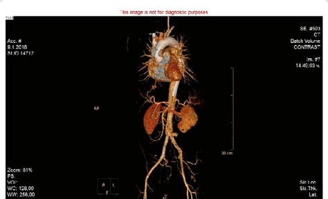 3D CT aortography reconstruction 6 months after the procedure: Blood... | Download Scientific ...