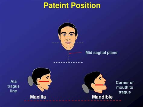 Bisecting angle technique