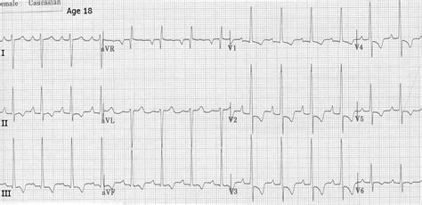 Left Ventricular Hypertrophy - Causes, Symptoms, Diagnosis & Treatment