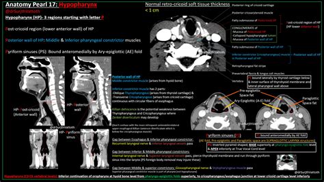 Pyriform Sinus Diagram