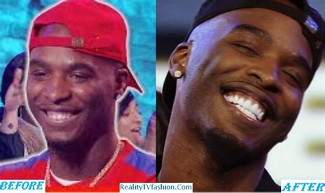 Hitman Holla Teeth Fixed, Before and After