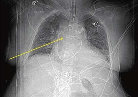 Pulmonary Artery Catheter Placement