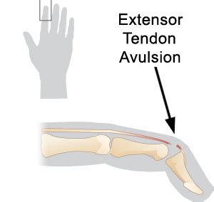 Extensor Tendon Injuries | 🩺Singapore Sports & Orthopaedic Surgeon