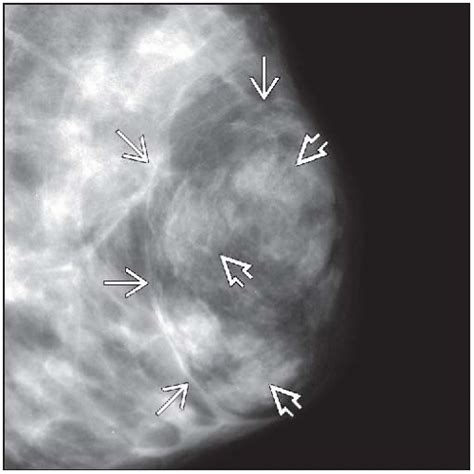 Hamartoma (Fibroadenolipoma) | Basicmedical Key