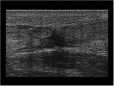 Musculoskeletal Joints and Tendons | 6.7 Ankle : Case 6.7.4 Full thickness achilles tendon ...