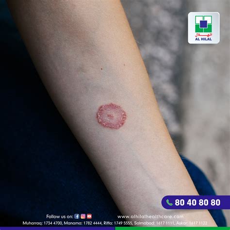 Ringworm: Symptoms, Diagnosis, Treatment, and Prevention