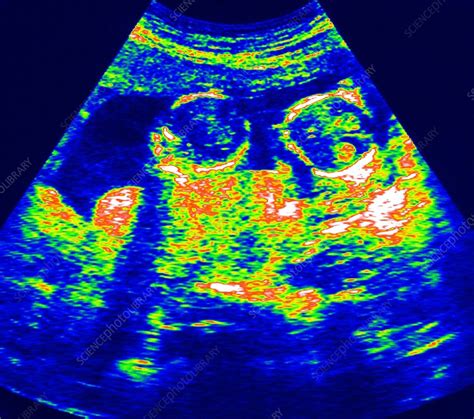 Scan of twins - Stock Image - P680/0357 - Science Photo Library